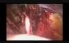 Laparoscopic Pelvic Lymphadenectomy