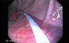 Juvenile Non Familial Polyposis of the Colon (34 of 37)