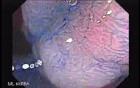 Sessile Tubulovillous Adenoma (6 of 13)