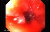 Perforation of a Esophageal Carcinoma after the procedure with hydrostatic balloon dilation (4 of 12)