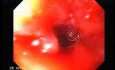 Perforation of a Esophageal Carcinoma after the procedure with hydrostatic balloon dilation (4 of 12)