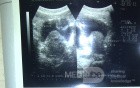 USG-hyperplasia prostate