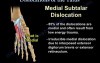 Dislocations Of The Talus 