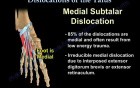 Dislocations Of The Talus 