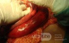 Mesenteric Ischemia (7 of 12)