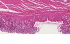 Erosion - Histopathology - Stomach