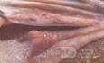 Early Gastric Cancer (12 of 21)