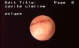 Hysteroscopic Aspect Of Endometrial Polyps