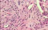 Perforation of a Esophageal Carcinoma after the procedure
 with hydrostatic balloon dilation (12 of 12)