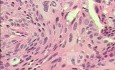 Perforation of a Esophageal Carcinoma after the procedure
 with hydrostatic balloon dilation (12 of 12)