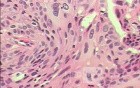 Perforation of a Esophageal Carcinoma after the procedure
 with hydrostatic balloon dilation (12 of 12)