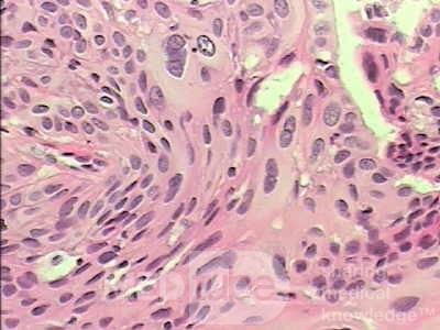 Perforation of a Esophageal Carcinoma after the procedure
 with hydrostatic balloon dilation (12 of 12)