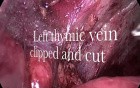 VATS - thymectomy