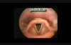Laryngeal Movements