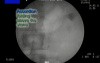 Stone Management Device - Fluoroscopy