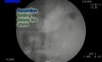Stone Management Device - Fluoroscopy