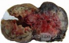 Jejunal Gastrointestinal Stromal tumor (GIST) (7 of 86)