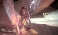 SILS of a gallbladder