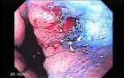 Hourglass Stomach - Chromoendoscopy, Part 1