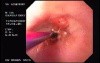 Zollinger- Ellison Syndrome - Gastric Ulcer with Gastrocolic Fistula (17 of 21)