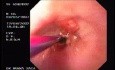 Zollinger- Ellison Syndrome - Gastric Ulcer with Gastrocolic Fistula (17 of 21)