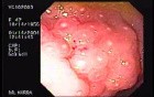 Amebic Colitis