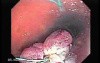 Huge Mass Of The Descending Colon (16 of 25)