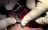 Implant Placement - Implant Surgery, #5-6-7 Sites