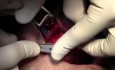 Implant Placement - Implant Surgery, #5-6-7 Sites