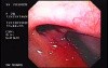 Flexible Endoscopic Suturing - Placement of Ti-Knot Device