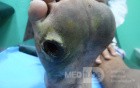 Diabetic Foot Ulcer - Neuropathic - Filled With Herbal Material