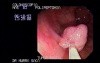 Video Colonoscopic view of a Polypectomy