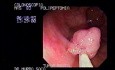 Video Colonoscopic view of a Polypectomy