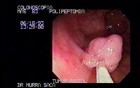 Video Colonoscopic view of a Polypectomy