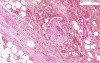 Dry gangrene - Histopathology of skin