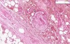 Dry gangrene - Histopathology of skin