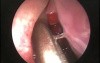 Maxillary Sinus Cholesterol Cyst - Endoscopic Removal
