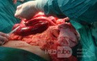 Mesenteric Ischemia (11 of 12)