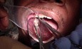 Don'T Fracture That Temporary Crown!
