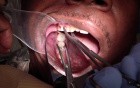 Don'T Fracture That Temporary Crown!