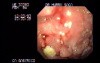 Infiltrating Gastric Carcinoma - Endoscopy