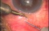 Repeated Transciliary Filtration