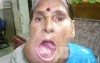 Large Maxillary Tumour