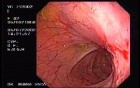 Crohn's Disease - Endoscopy (11 of 28)