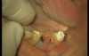 Loading Of Early Prosthesis 16-17-25-26-27 (1/3)