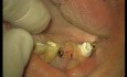 Loading Of Early Prosthesis 16-17-25-26-27 (1/3)