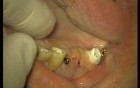Loading Of Early Prosthesis 16-17-25-26-27 (1/3)
