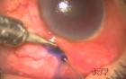 Neovascular Glaucoma - TCF With Fugo Blade