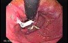 Longstanding gastroesophageal reflux disease (1 of 7)