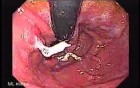 Longstanding gastroesophageal reflux disease (1 of 7)